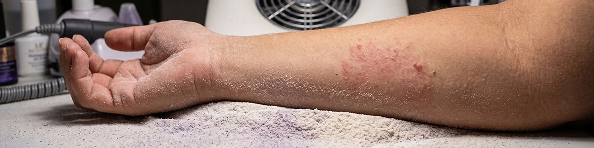 A close-up of a person’s forearm, showing irritated, red, patchy skin with small bumps—potentially uncured gel nail allergy symptoms—rests on a table dusted with white powder. Manicure tools and bottles in the background hint at a salon or contact dermatitis nail tech setting. Read more at Aerovex Systems (aerovexsystems.com)
